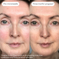 Plump Up Dermaroller 0.5mm