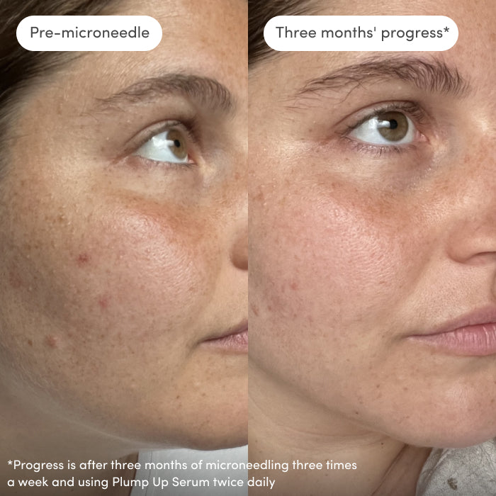 Plump Up Dermaroller 0.5mm