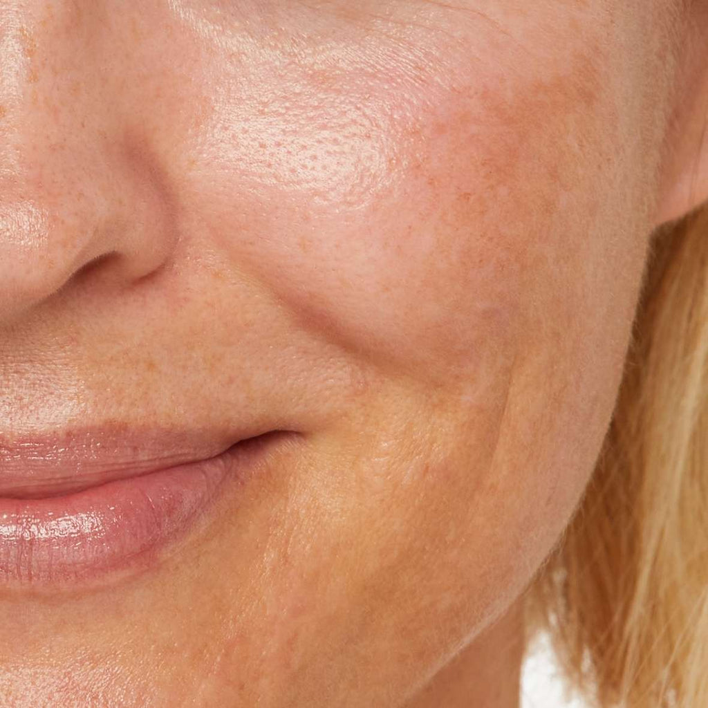 The different types of pigmentation explained