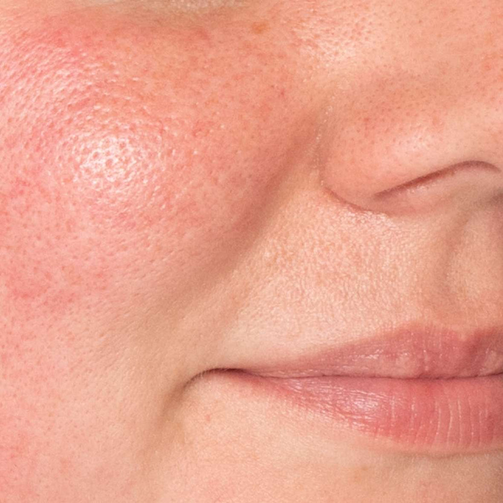What is rosacea? Plus how to calm flare-ups