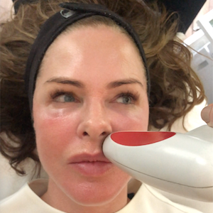 Laser Facial with Teresa Tarmey